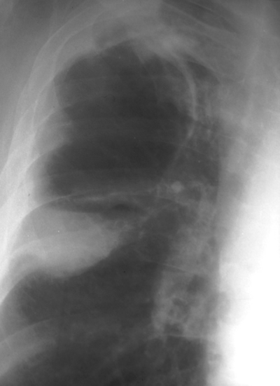 Image D. 3/99 Note aspergilloma