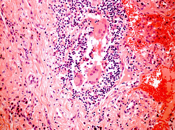 Lung bullae with necrotic tissue containing aspergillus conidial heads ...