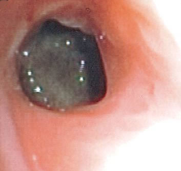 Fig 4 Aspergilloma seen on bronchoscopy. 