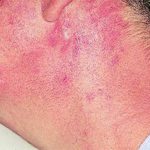 Patient AB: Discoid lupus erythematosus following 12 months voriconazole therapy. This improved with use of sunblock factor 30 and resolved after discontinuation of voriconazole, 2 months later.