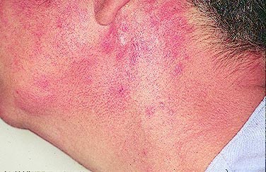 Patient AB: Discoid lupus erythematosus following 12 months voriconazole therapy. This improved with use of sunblock factor 30 and resolved after discontinuation of voriconazole, 2 months later.