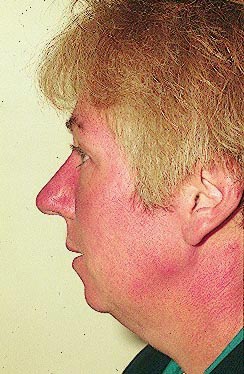 Patient AB: Voriconazole rash. Following 8 weeks of Voriconazole, patient had remarkable facial erythema, most consistent with sun exposure because of sparing of her neck.