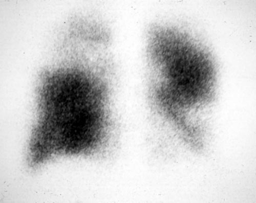 Lung perfusion scan, pt RR Technetium perfusion scan of the lungs showing left lower lobe and right upper zone defects, matching the radiological areas of abnormality. 