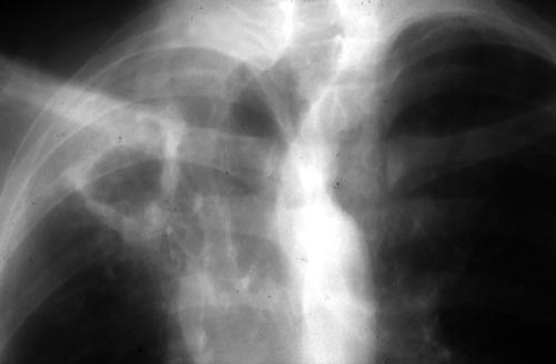 Image B. June 1992 Recurrence of disease.Chest radiograph demonstrating cavitary invasive aspergillosis.