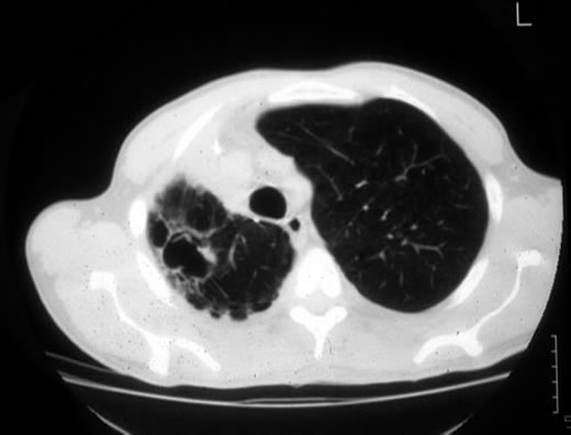 Image L. This CT scan of the thorax illustrates the formation of multiple cavities, without aspergillomas previously in ‘normal’ lung a non immunocompromised patient. The appearances are reminiscent of tuberculosis and coccidioidomycosis.