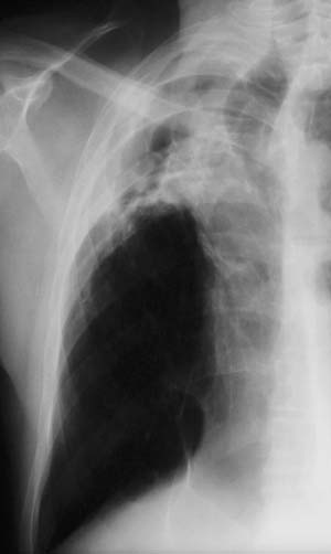 Image H. April 04 Back to where he was in terms of symptoms when he stopped itraconzole. CRP, <5, ESR 20, Aspergillus precipitins titre 1:8. Further radiological change. 