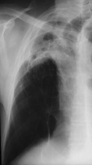 Image G. October 03 Stable and reasonable, with weight loss reversed, CRP <5, ESR 13 and Aspergillus precipitins at a titre of 1:16 . Further evolution of radiological features. 