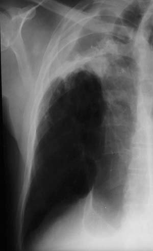 Image F. April 03 No better on itraconazole despite high concentrations of itraconazole in blood. 