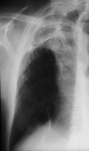 Image E. January 03 Much worse with lethargy, anorexia, weight loss and radiological deterioration on Chest Xray (link). Aspergillus precipitins rose to a titre of 1:32 , and CRP to 30, and ESR to 49. He was restarted on itraconazole.