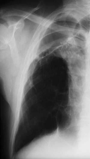 Image D. September 2002 Well, although had a respiratory infection. CRP and ESR normal in August 02, aspergillus precipitins positive at a titre of 1:2. 