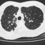 Image B. Bilateral multilobar bronchiectasis with surrounding peribronchial oedema and some evidence of inhomogeneity of the pulmonary parenchyma on the left, with hyperexpansion, indicating chronic air trapping in the left upper lobe particularly.