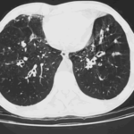 Images C & D. Bilateral bronchiectasis in the context of corticosteroid dependant ABPA, which improved markedly with oral itraconazole therapy.