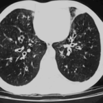 Images C & D. Bilateral bronchiectasis in the context of corticosteroid dependant ABPA, which improved markedly with oral itraconazole therapy.