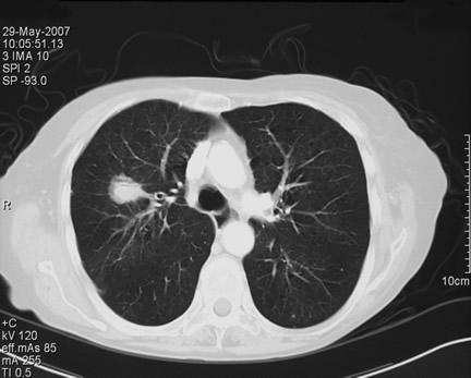 Invasive Pulmonary Aspergillosis With Adenocarcinoma Of The Lung ...