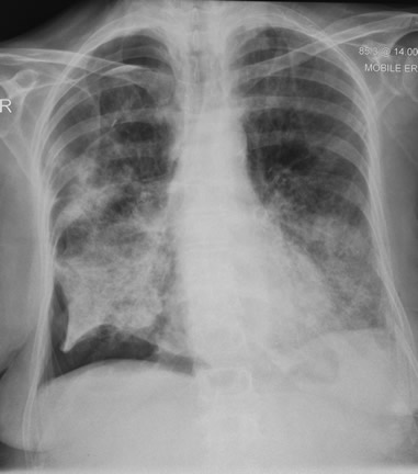  Image 4 06/08/07 CXR showing extension of consolidation to both lung bases and right basal pneumothorax despite antibiotics and itraconazole. 