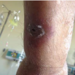 Zosteriform scatris with erythematous halo on the skin of the patient with acute myelogenous leukemia during the febrile neutropenia attack.