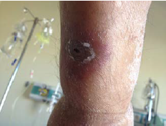 Zosteriform scatris with erythematous halo on the skin of the patient with acute myelogenous leukemia during the febrile neutropenia attack.