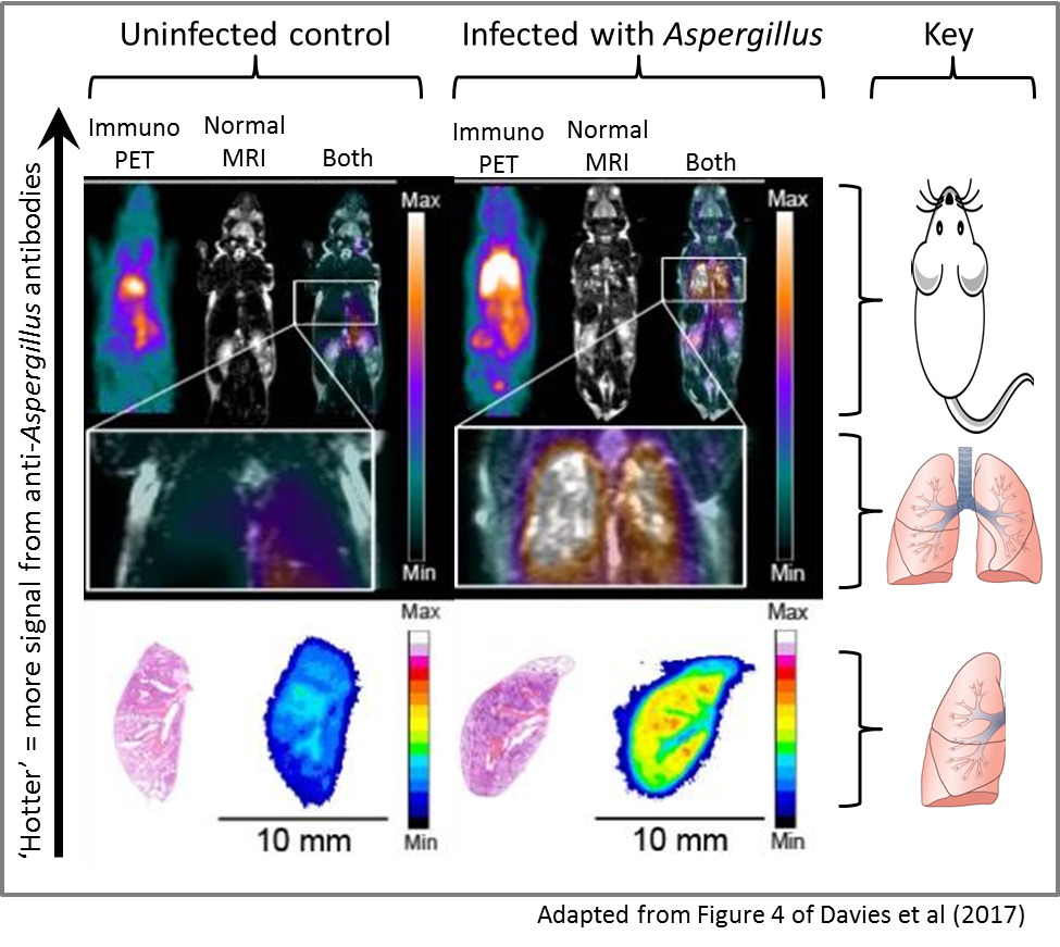 Aspergillus diagnostics immunopet scan