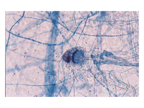 Chronic invasive sinus aspergillosis caused by Aspergillus terreus